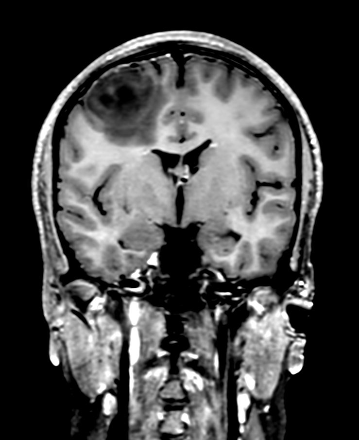 3D T1w TSE +gado - Coronal Reformat