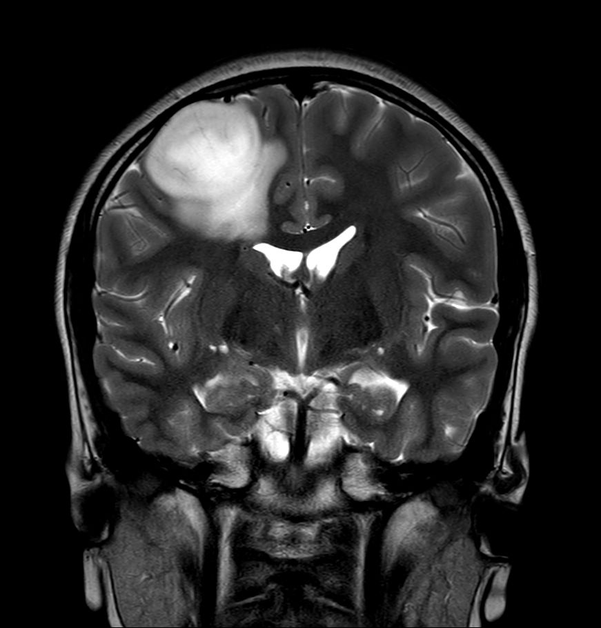 T2w TSE <b>Compressed SENSE</b>