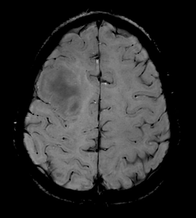 SWIp (Modulus) <b>Compressed SENSE</b>