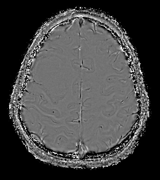 SWIp (Phase) <b>Compressed SENSE</b>