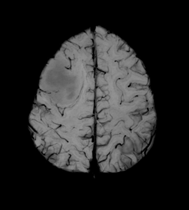 SWIp (minIP) <b>Compressed SENSE</b>