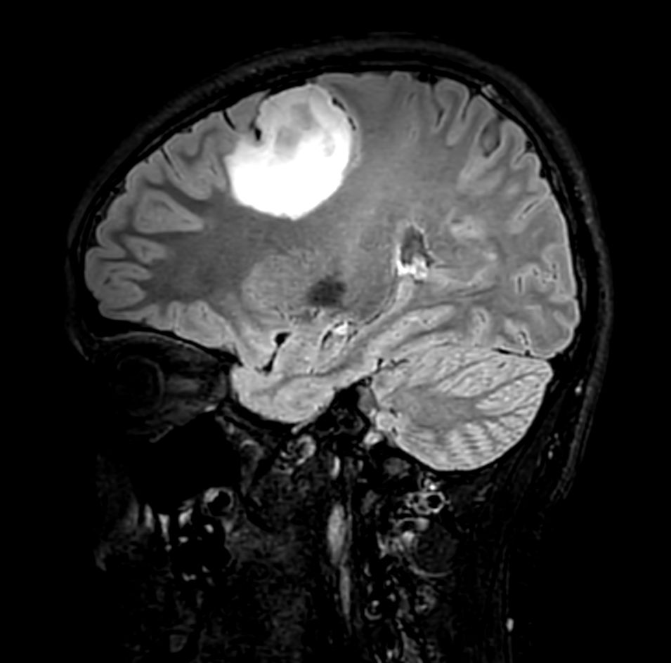 Sagittal 3D T2w FLAIR <b>Compressed SENSE</b>