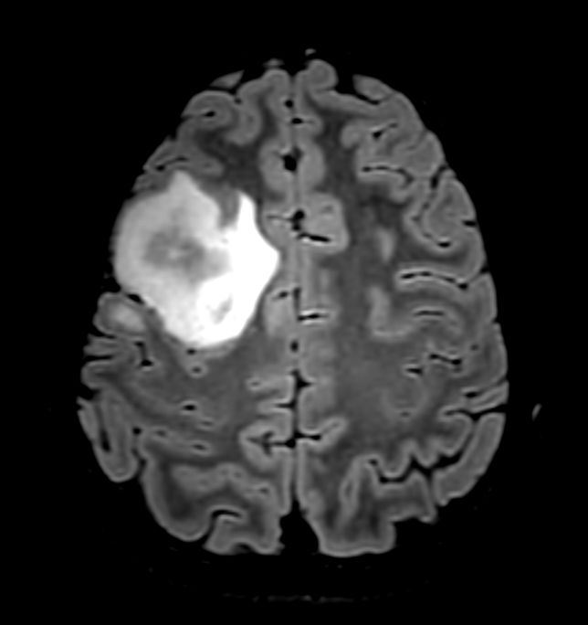 3D T2w FLAIR - Axial Reformat <b>Compressed SENSE</b>