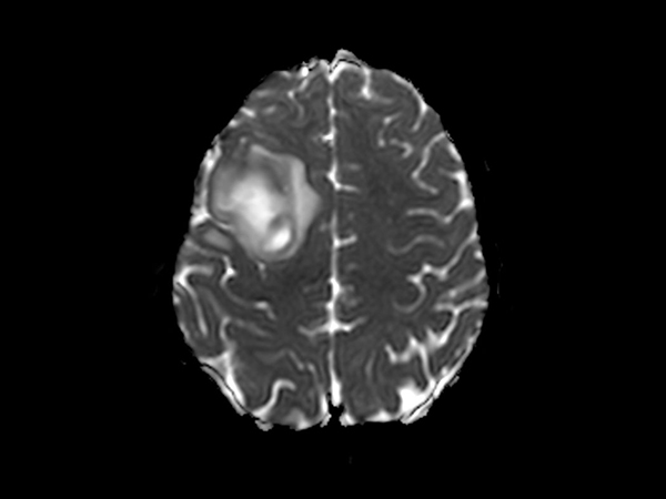 Diffusion (ADC)