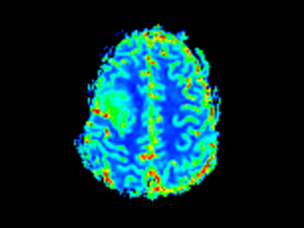 T2* Perfusion (Cerebral Blood Volume)