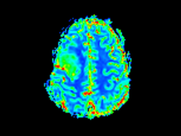 T2* Perfusion (Cerebral Blood Flow)