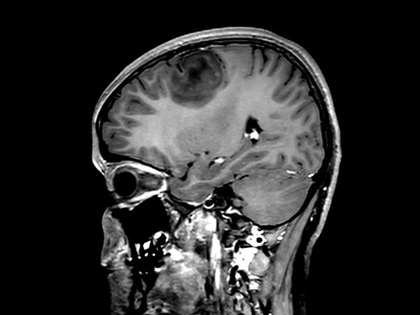 Sagittal 3D T1w TSE +gado <b>Compressed SENSE</b>