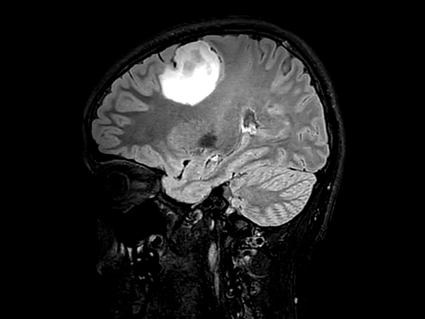 Sagittal 3D T2w FLAIR <b>Compressed SENSE</b>