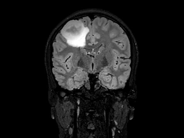 3D T2w FLAIR - Coronal Reformat <b>Compressed SENSE</b>