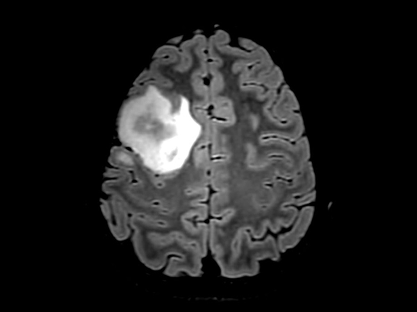 3D T2w FLAIR - Axial Reformat <b>Compressed SENSE</b>