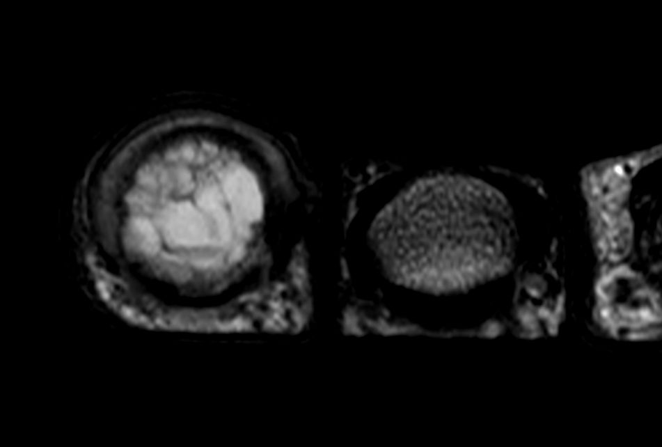 T2w TSE <b>Compressed SENSE</b>