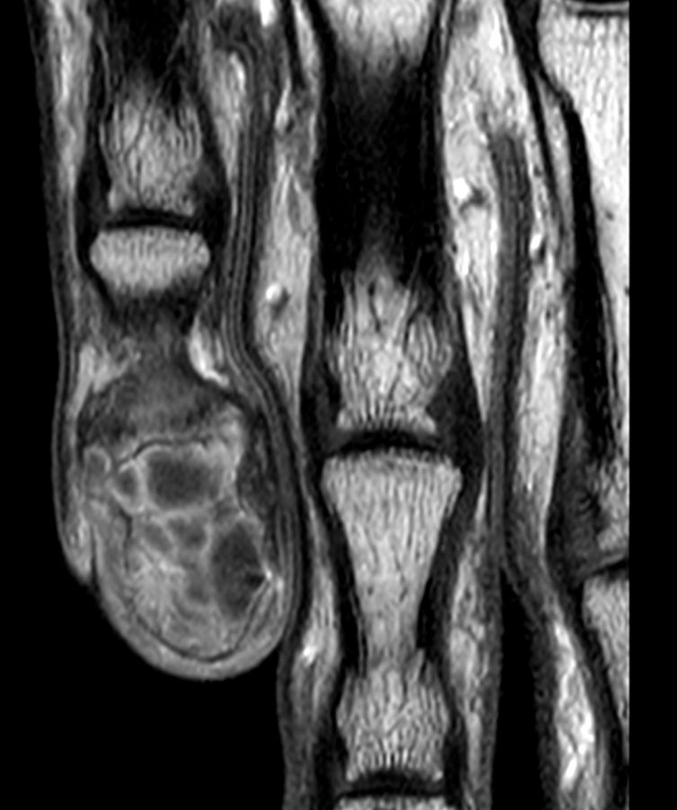 T1w TSE +gado <b>Compressed SENSE</b>