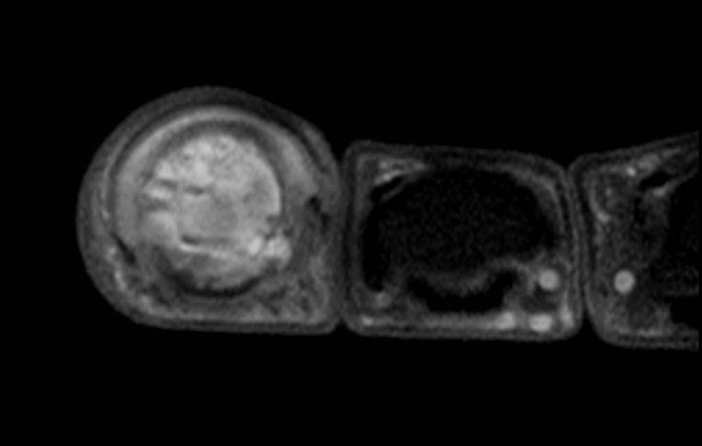 T1w TSE FatSat +gado <b>Compressed SENSE</b>