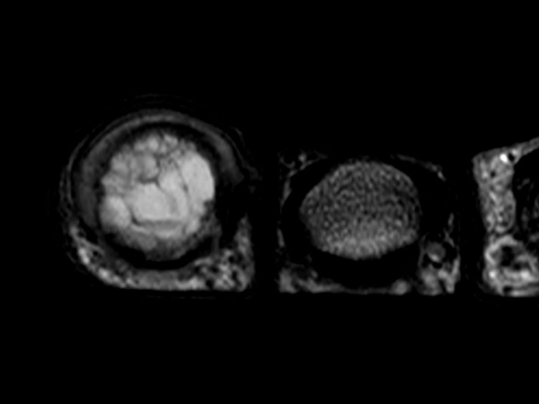 T2w TSE <b>Compressed SENSE</b>