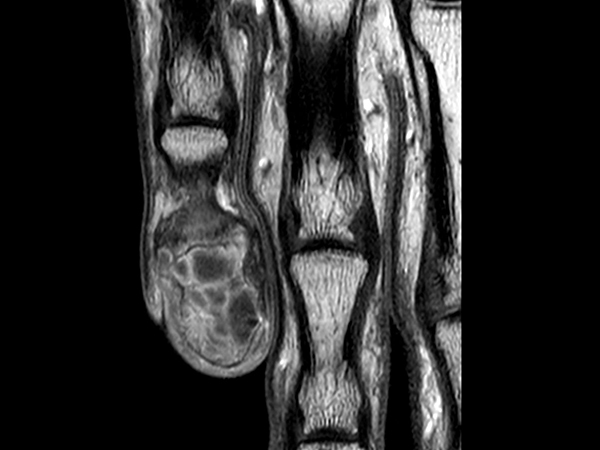 T1w TSE +gado <b>Compressed SENSE</b>