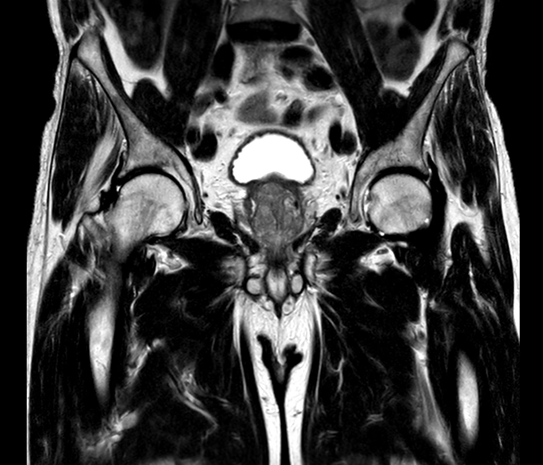 T2w TSE <b>Compressed SENSE</b>