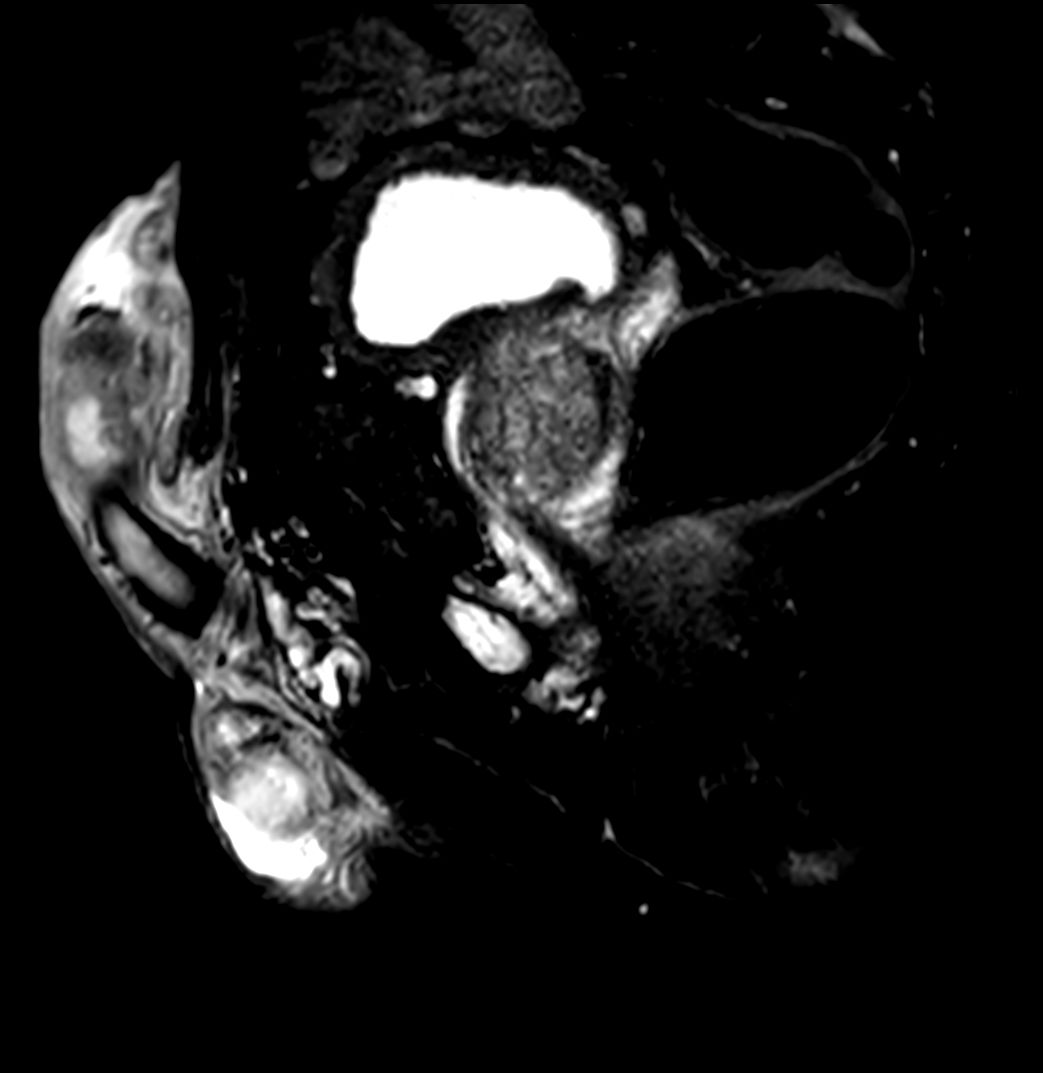 T2w TSE FatSat <b>Compressed SENSE</b>
