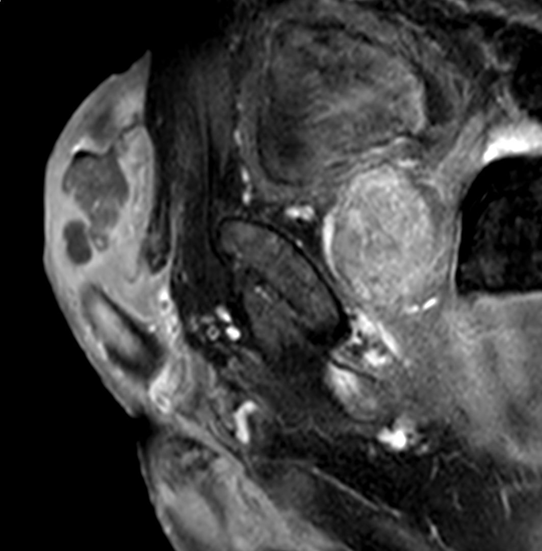 T1w TSE +gado <b>Compressed SENSE</b>