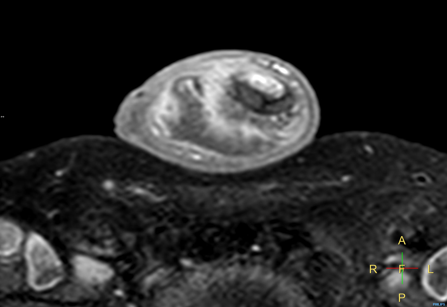 T1w TSE FatSat +gado <b>Compressed SENSE</b>