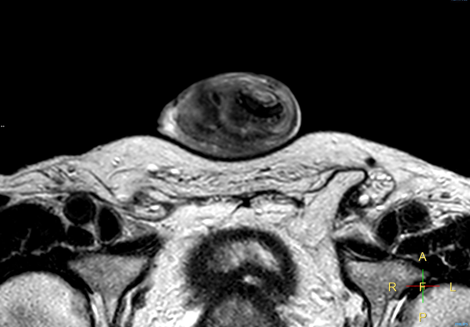 T2w TSE <b>Compressed SENSE</b>