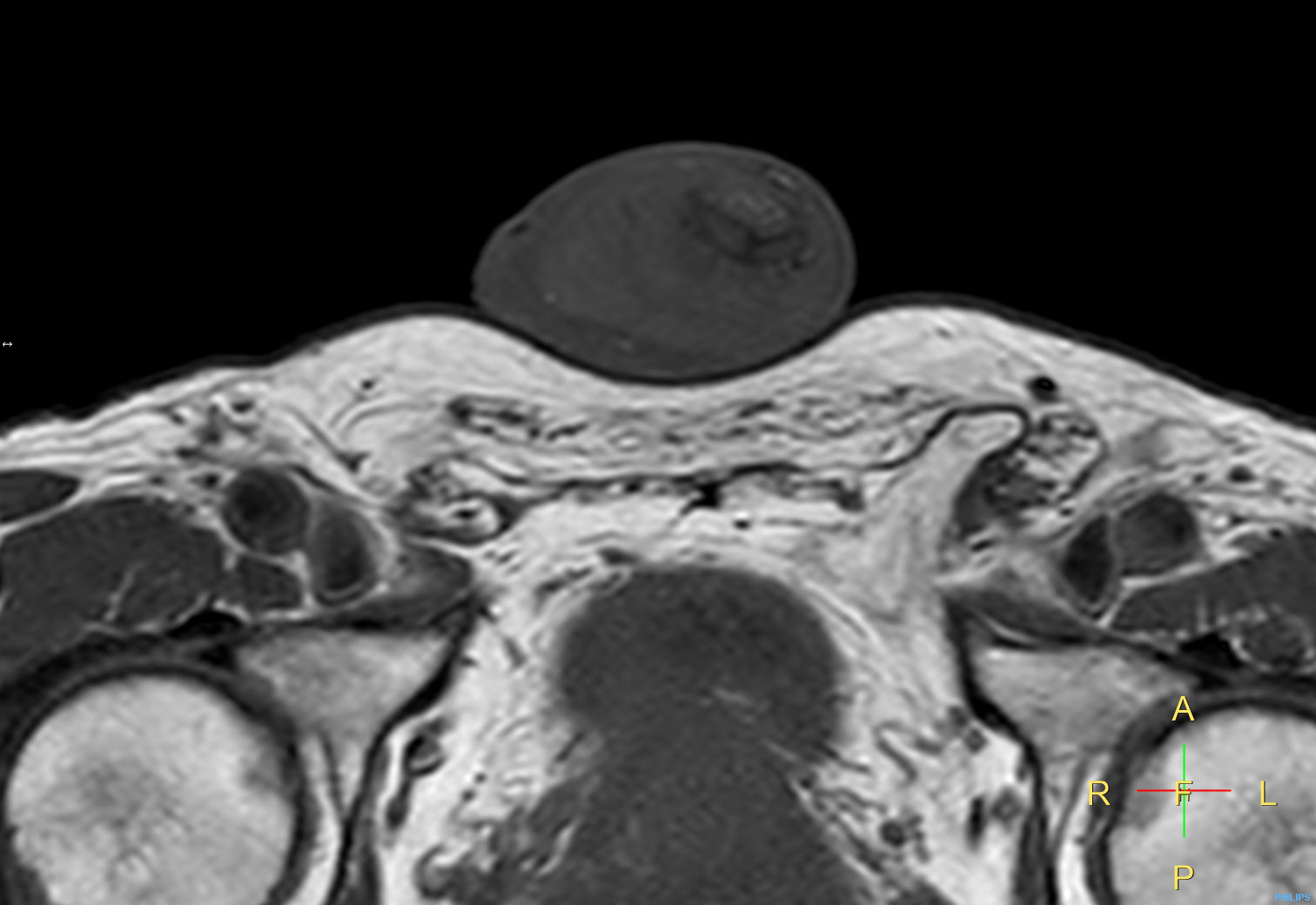 T1w TSE <b>Compressed SENSE</b>