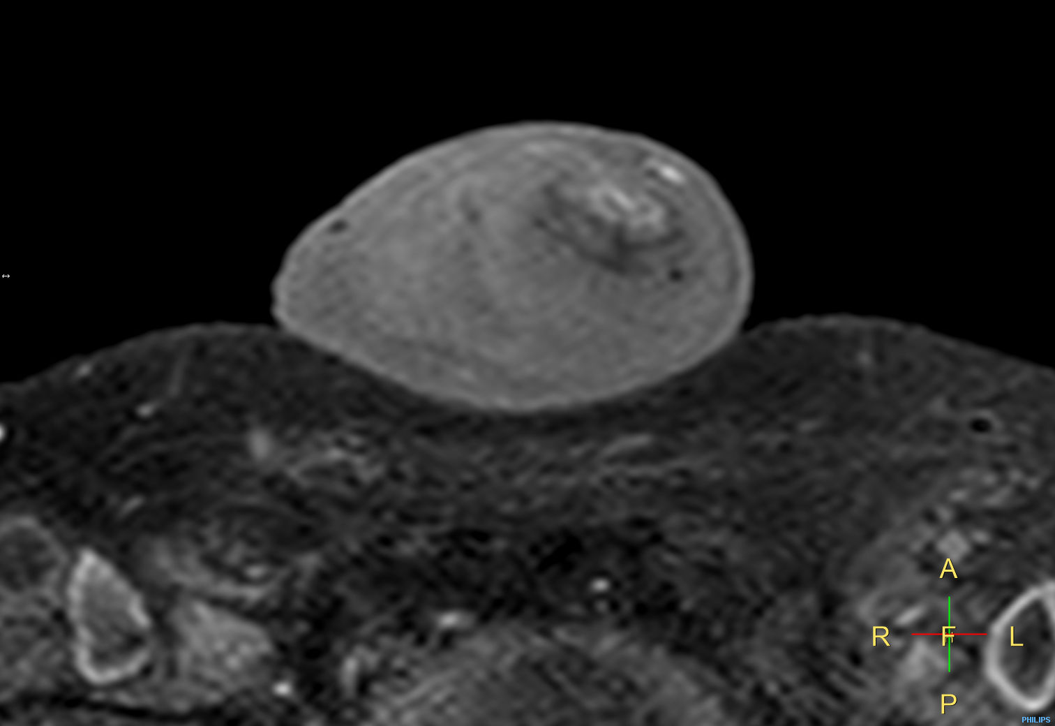 T1w TSE FatSat <b>Compressed SENSE</b>