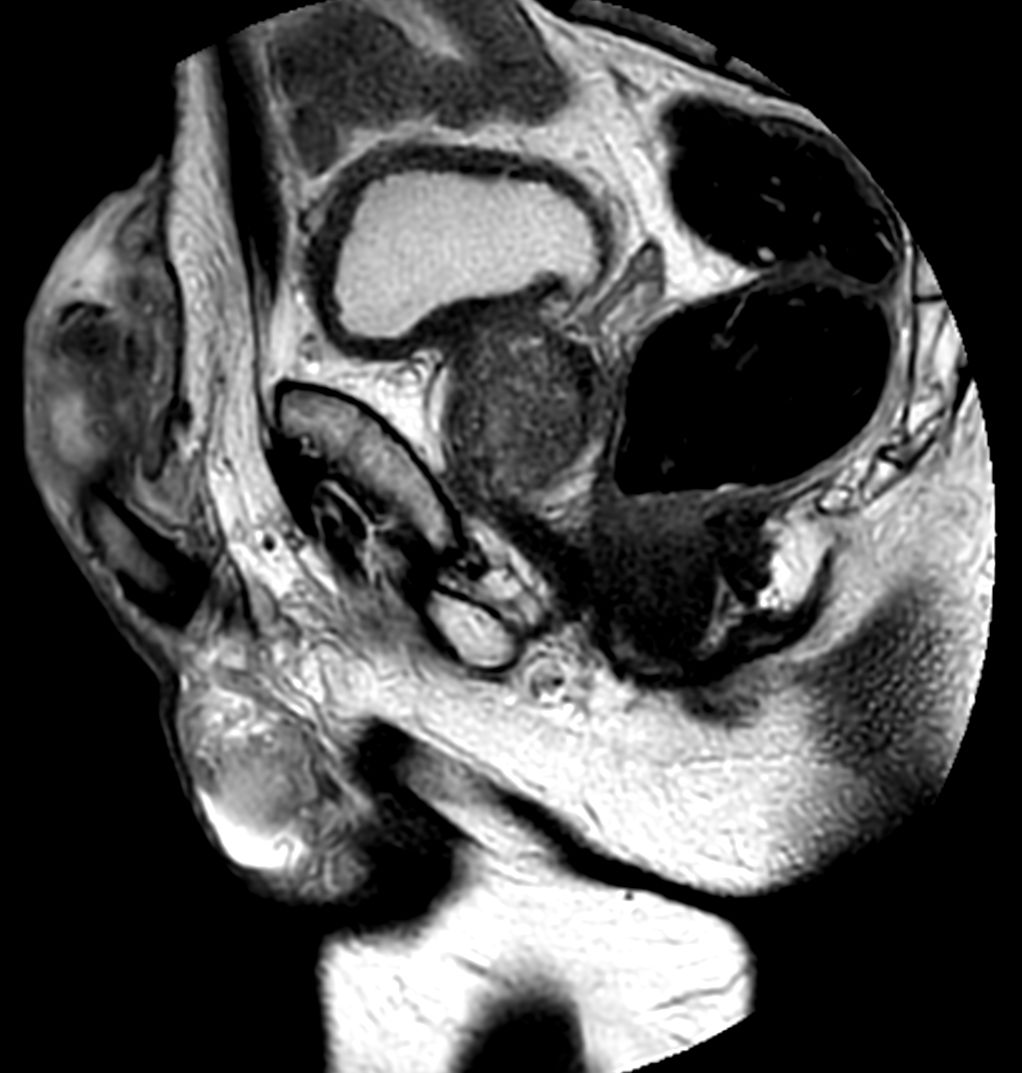 T2w TSE MultiVane XD