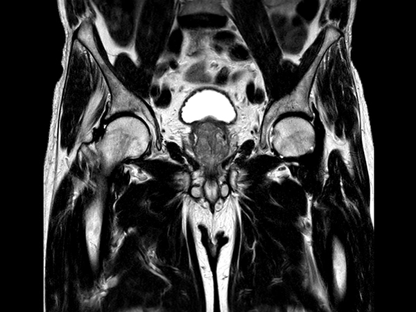 T2w TSE <b>Compressed SENSE</b>