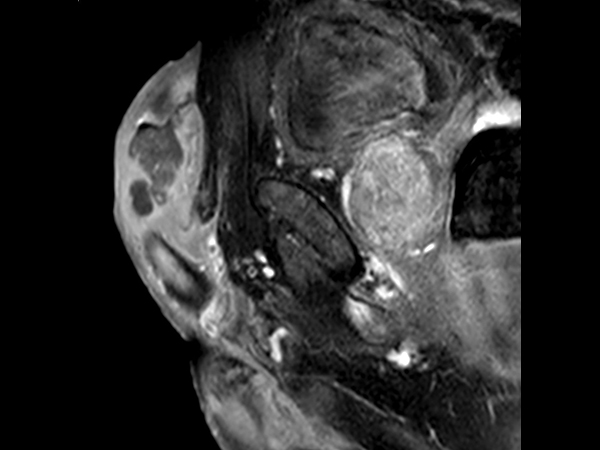 T1w TSE +gado <b>Compressed SENSE</b>