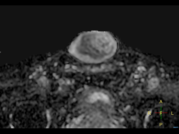 Diffusion (ADC)