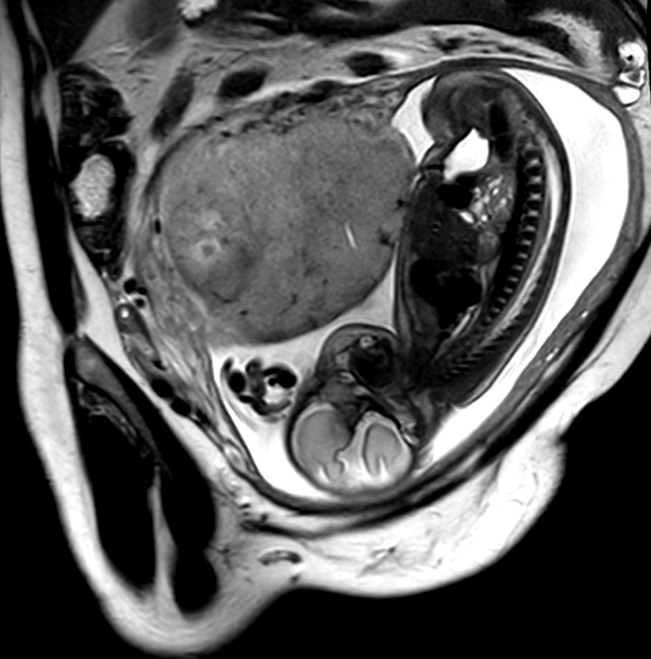 Sagittal T2w TSE single shot (Spine)