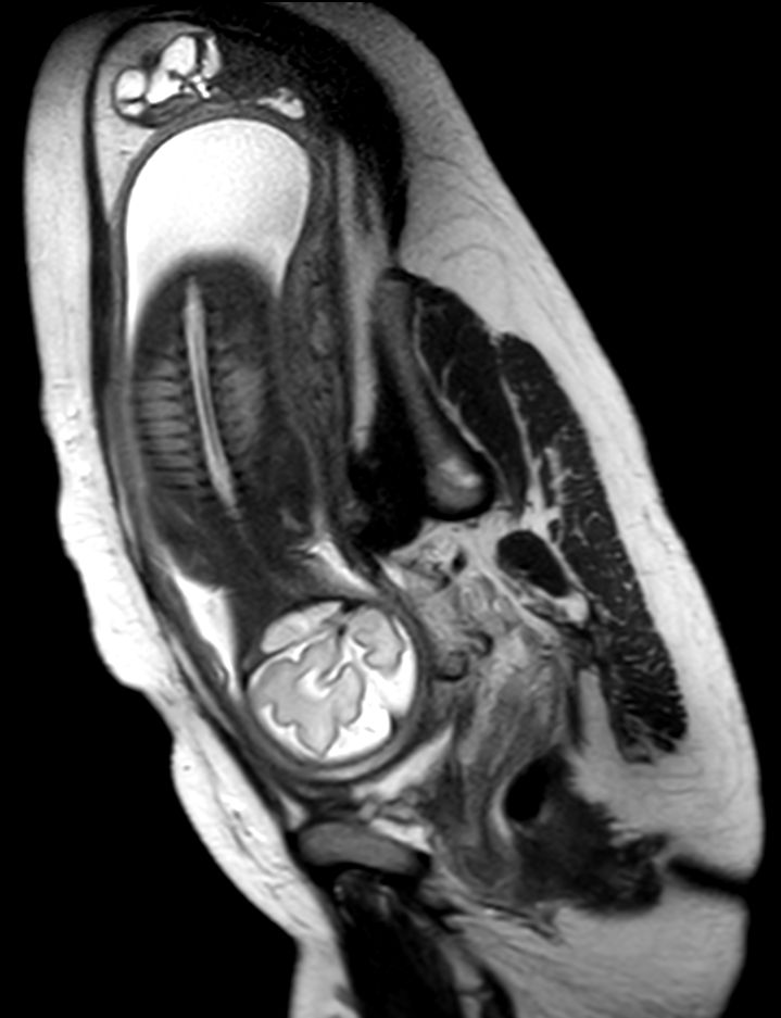 Coronal T2w TSE single shot (Spine)