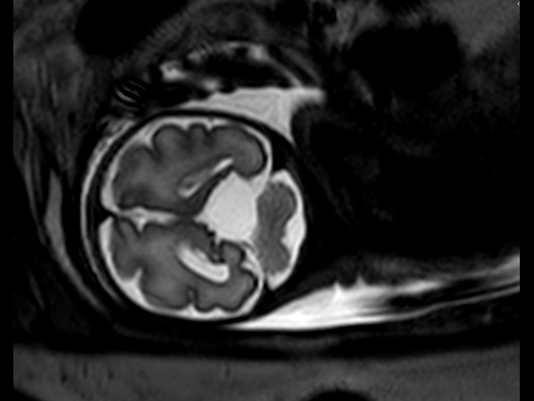 Coronal T2w TSE single shot