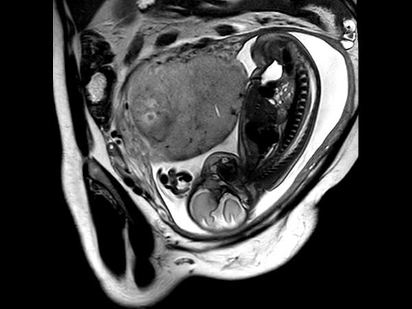 Sagittal T2w TSE single shot (Spine)