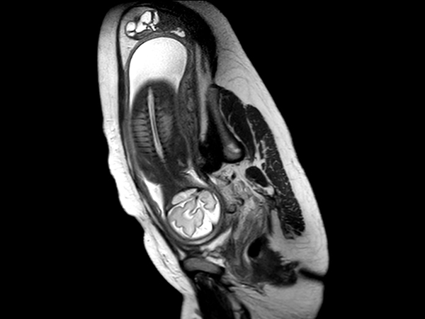 Coronal T2w TSE single shot (Spine)