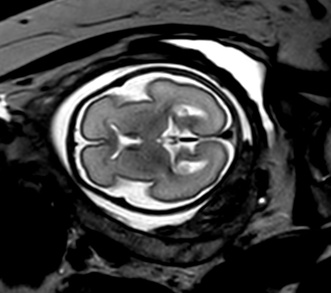 Axial T2w TSE single shot<b>Compressed SENSE</b>