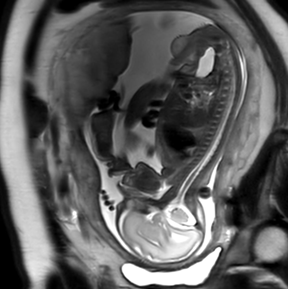 Sagittal T2w TSE single shot (Spine)<b>Compressed SENSE</b>