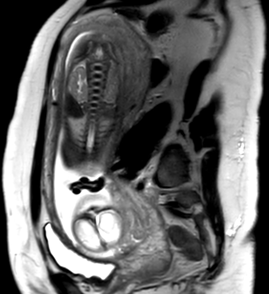 Coronal T2w TSE single shot (Spine)<b>Compressed SENSE</b>