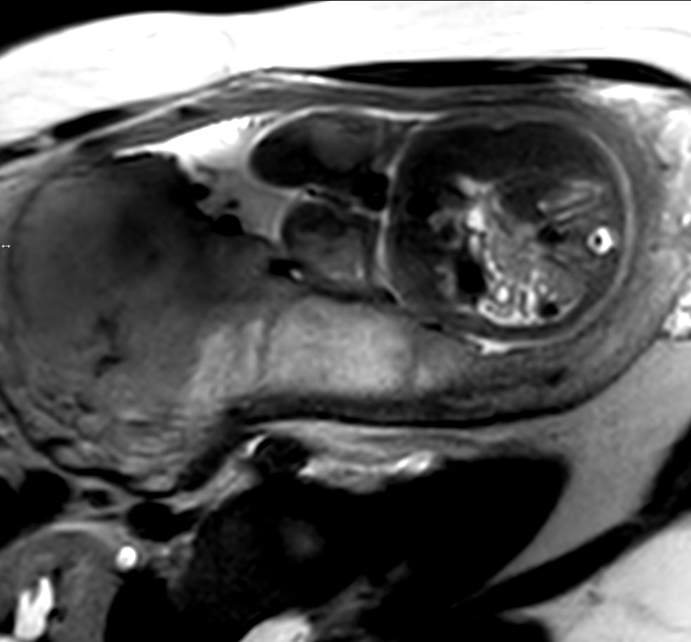 Axial T2w TSE single shot (Spine)<b>Compressed SENSE</b>