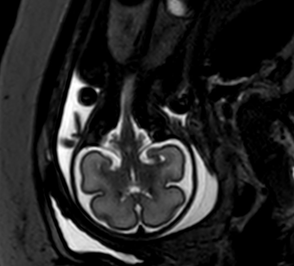 Coronal T2w TSE single shot<b>Compressed SENSE</b>