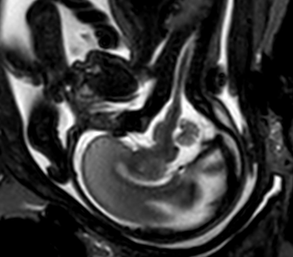 Sagittal T2w TSE single shot<b>Compressed SENSE</b>