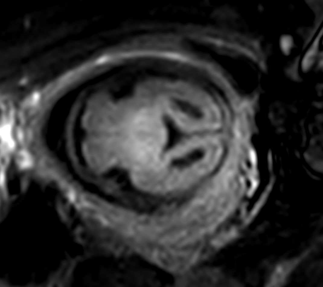 Axial T2w FLAIR<b>Compressed SENSE</b>