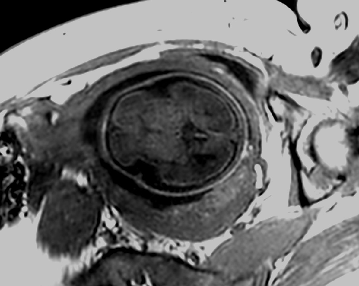 Axial 3D T1w TFE<b>Compressed SENSE</b>