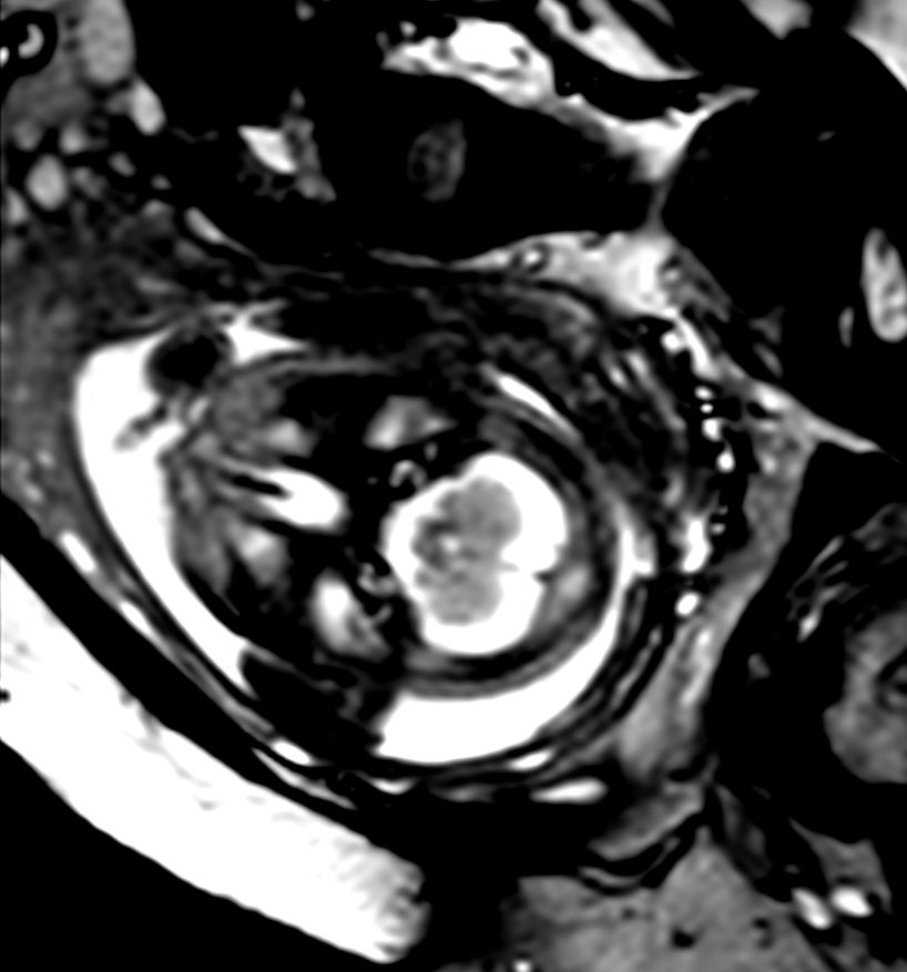 Axial bFFE (IAC)<b>Compressed SENSE</b>