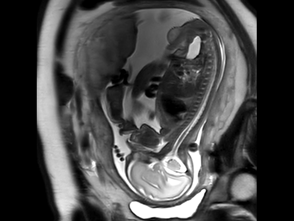 Sagittal T2w TSE single shot (Spine)<b>Compressed SENSE</b>