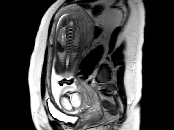 Coronal T2w TSE single shot (Spine)<b>Compressed SENSE</b>