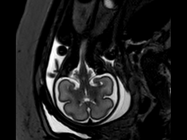 Coronal T2w TSE single shot<b>Compressed SENSE</b>