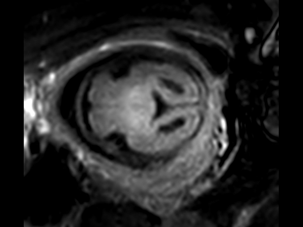 Axial T2w FLAIR<b>Compressed SENSE</b>