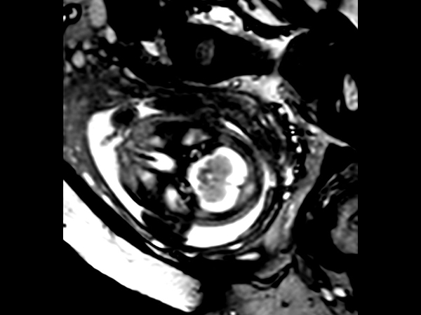 Axial bFFE (IAC)<b>Compressed SENSE</b>