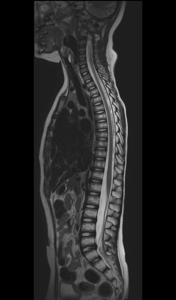Sagittal T2w TSE
